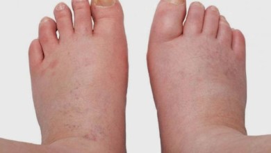 pair of swollen legsfeet