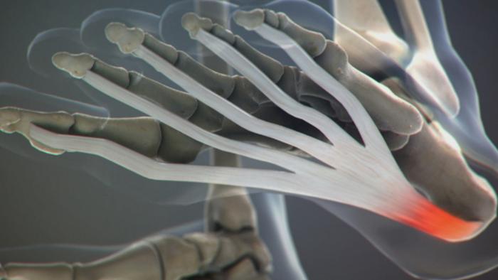 طرق معالجة آلام القدم ومسمار الكعب 018480733 30300