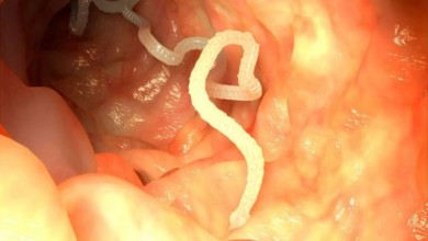 دودة شريطية في دماغ