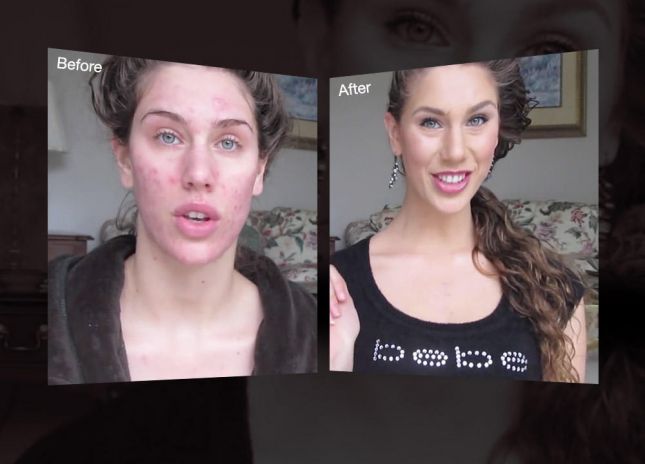 1449751456 slider acne