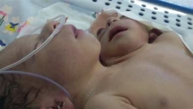 ولادة طفلة برأسين وأربعة أذرع طفلة برأسين وأربعة أذرع