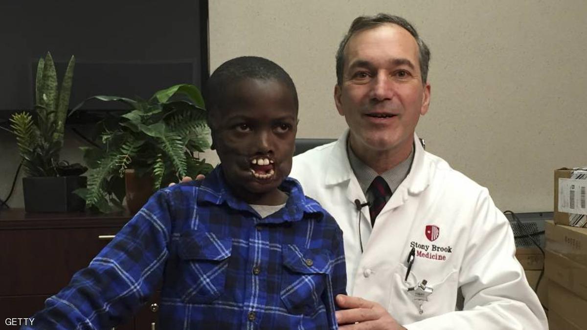 زراعة شفتين لطفل فقدهما بهجوم قرد شمبانزي عليه طفل يهاجمة قرد