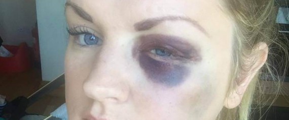 عريس "ملاكم" يضرب وصيفتي عروسه مشوِّهاً وجهيهما وصيفة العروس