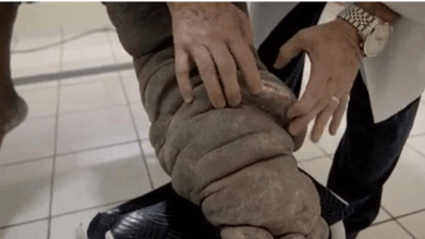 بالصور.. بعوضة تحول برازيلياً إلى فيل رجل
