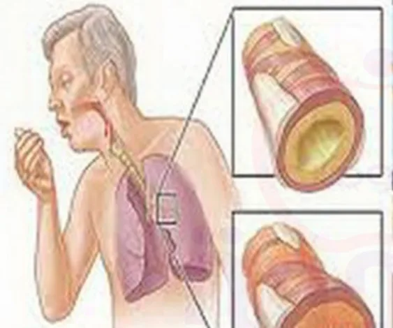 أفضل طرق تنظيف الرئتين : للمدخنين والبيئة الملوّثة تنظيف الرئتين