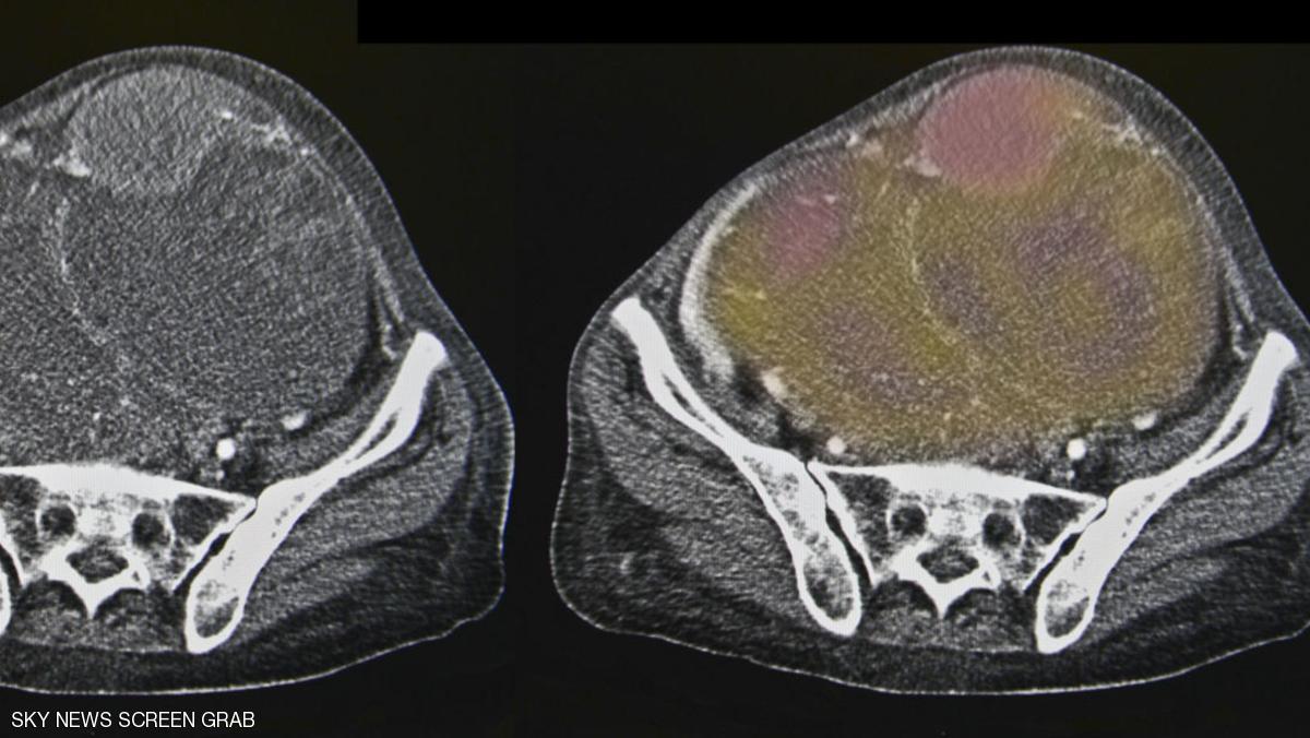 سرطان المبيض