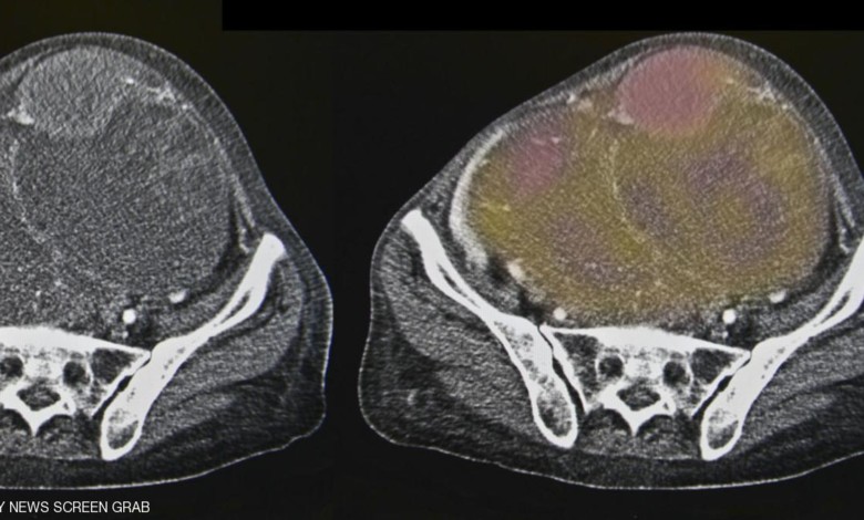 علاج ثوري لسرطان المبيض سرطان المبيض