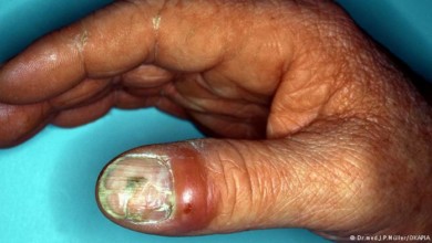 فطريات اظافر