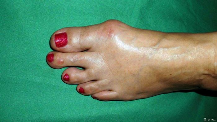 مرض الإبهام الأفحج... الوقاية والعلاج! 18650243 303