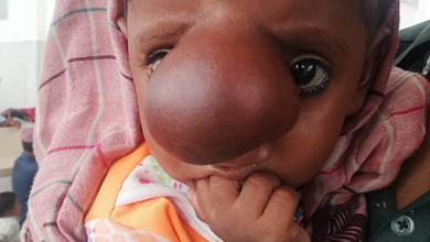 Khối u to như quả bóng tennis trên mặt cậu 450x375