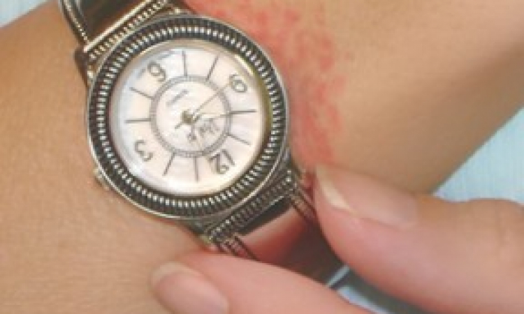 لمرضى حساسية المعادن.. مش أى اكسسوار ينفع تلبسه 228096 حساسية