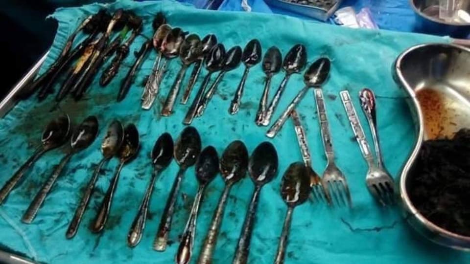 استخراج 20 ملعقة ومجوهرات من بطن مريض 21d0be33 d079 4765 839a