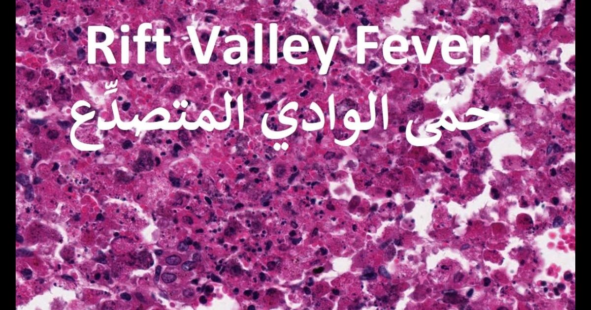 وفاة عشرات السودانيين بحمى الوادي المتصدّع وأكثر من 40 إصابة بمناطق الفيضان حمى الوادي المتصدع