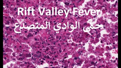حمى الوادي المتصدع