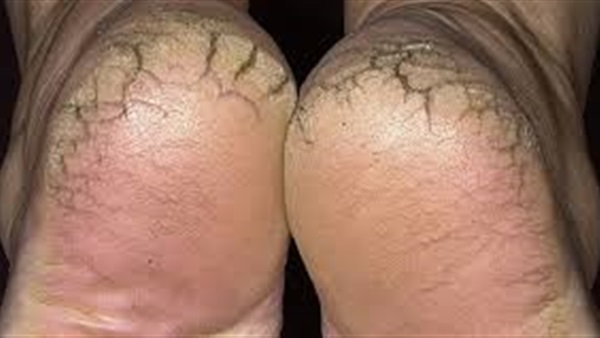 أعراض نقص فيتامين ب3.. التهاب الجلد وتشقق الكعبين تشقق القدمين1