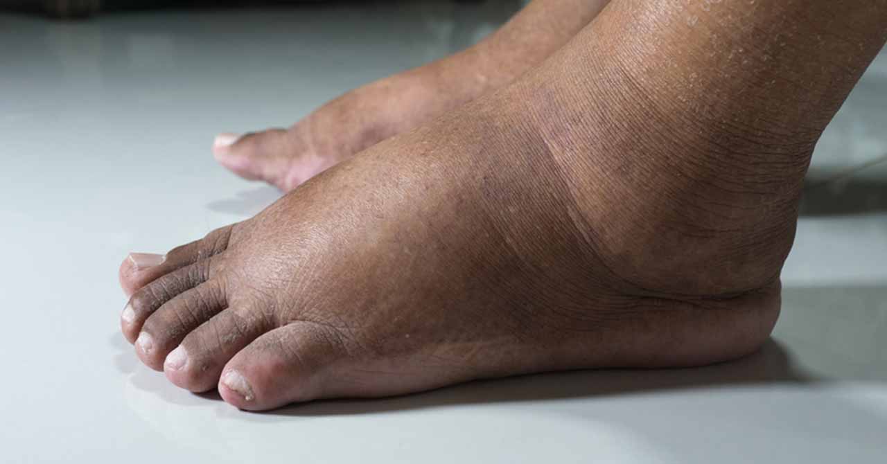 تورم القدمين ارجل