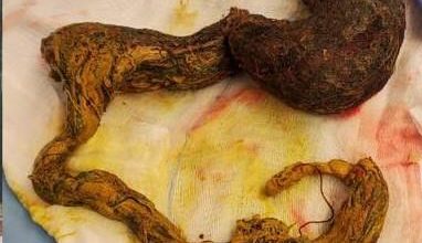 شعر في معدة طفلة