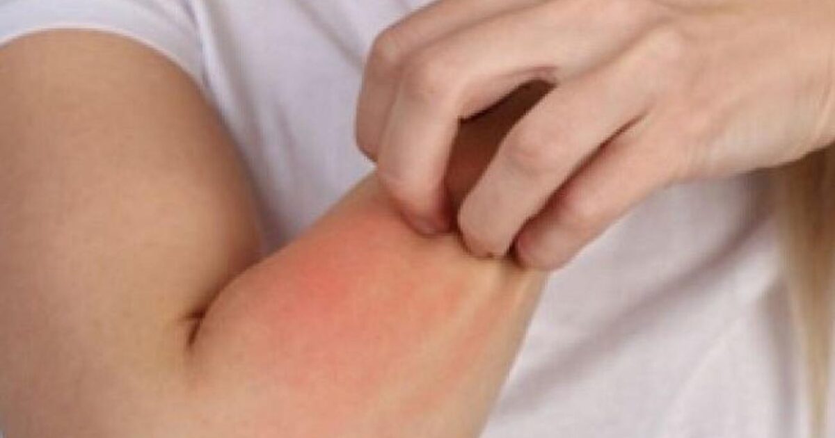 أطعمة تحارب التهاب الجلد وتمنح بشرة صحية ونقية التهاب الجلد