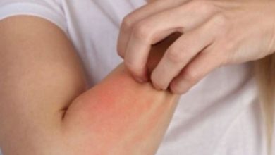 حساسية الطعام