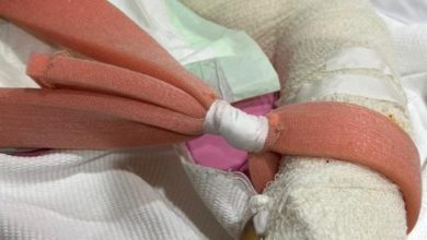"غراء عظمي".. ابتكار صيني لعلاج الكسور في 3 دقائق 2129a049 952e 4312 a8d1 c4dd65001b31