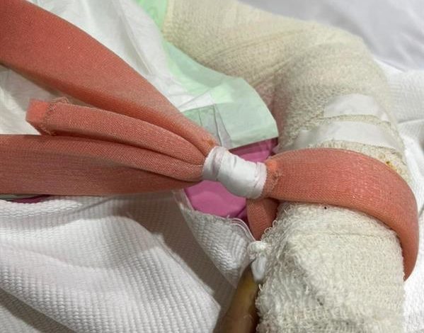 "غراء عظمي".. ابتكار صيني لعلاج الكسور في 3 دقائق 2129a049 952e 4312 a8d1 c4dd65001b31