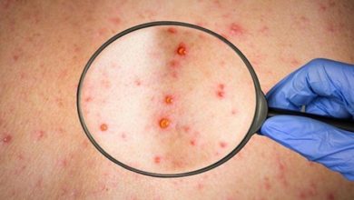 «الصحة العالمية»: رصد فايروس متحور يضم سلالتين من جدري القرود 127 124722 monkeypox disease rare virus 700x400