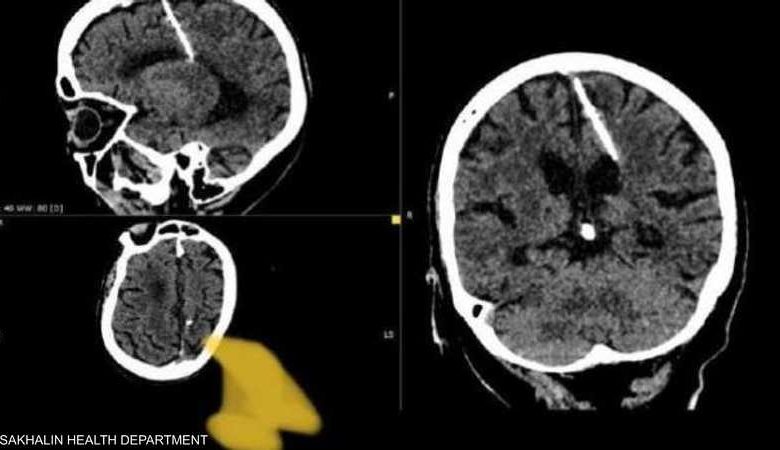 أطباء روس يعثرون على إبرة في دماغ امرأة منذ 80 عاماً 1 1659363