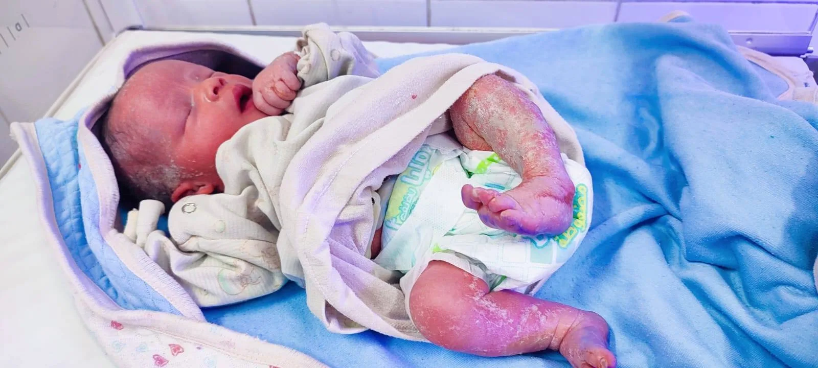 ولادة طفل شمعي نادرة بمستشفى مصري طفل شمعي