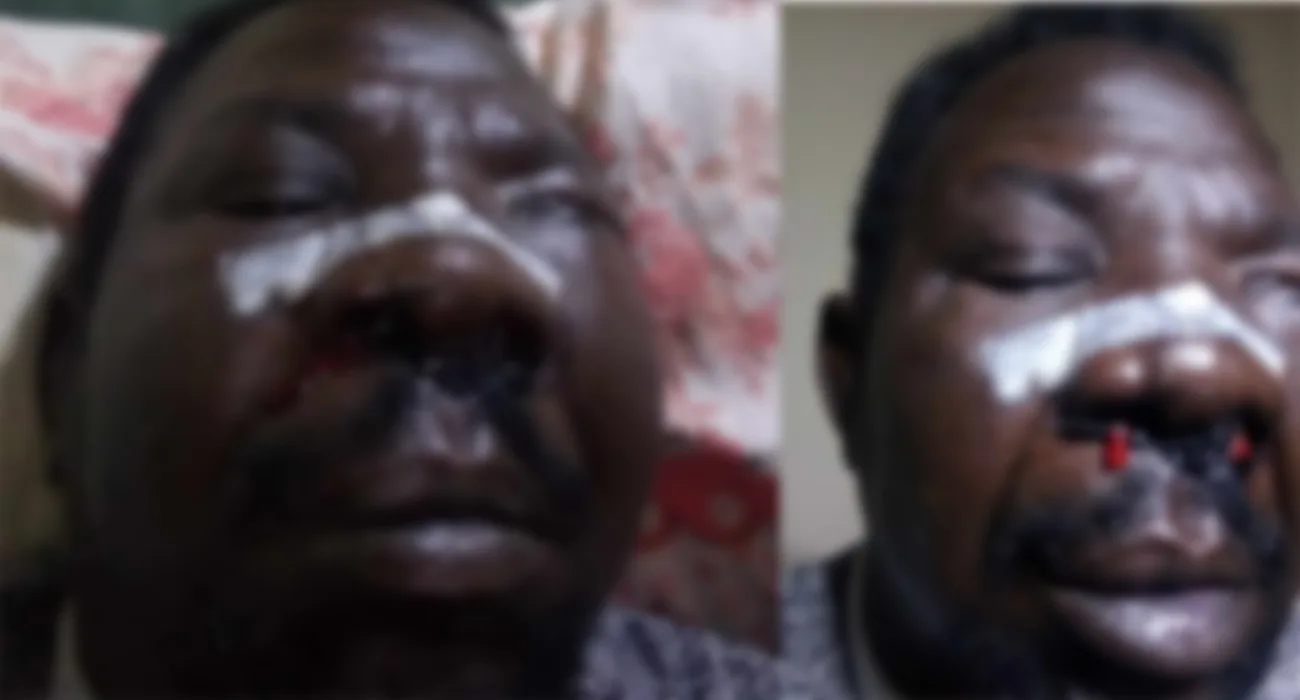 جندي سوداني يدفن عينه بيده ويستعد للعودة إلى القتال رغم الإصابة جندي سوداني