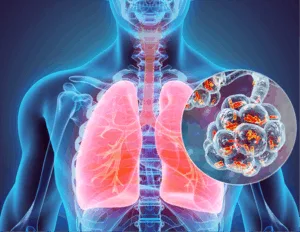 انتشار داء الفيالقة