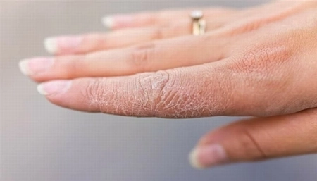 . 3 علامات جلدية قد تعني إصابتك بالسكري… لا تهملها! downloadfile1 3