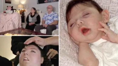 ولدت بلا دماغ