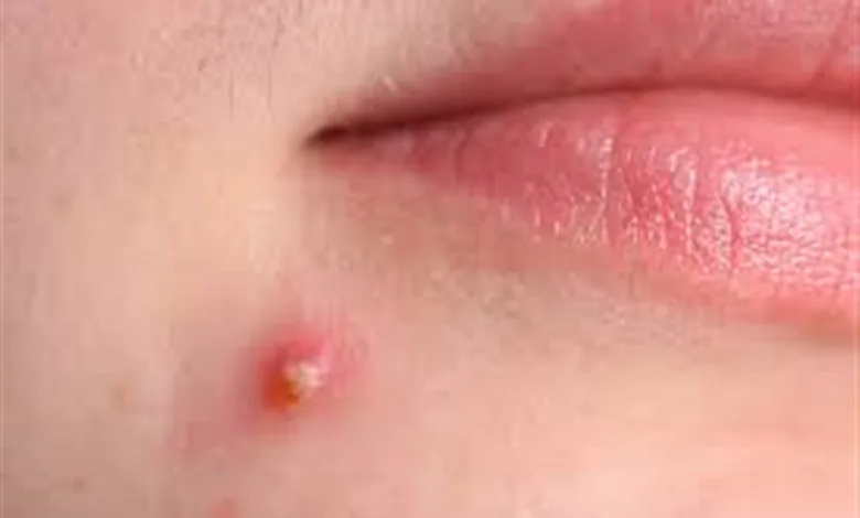 أطعمة تسبب حب الشباب: قائمه كاملة بالأطعمة التي تزيد التهاب البشرة وفق الدراسات حب الشباب