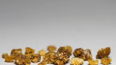 مصر... استخراج 58 حصوة من كلية مريض! حصوة 1