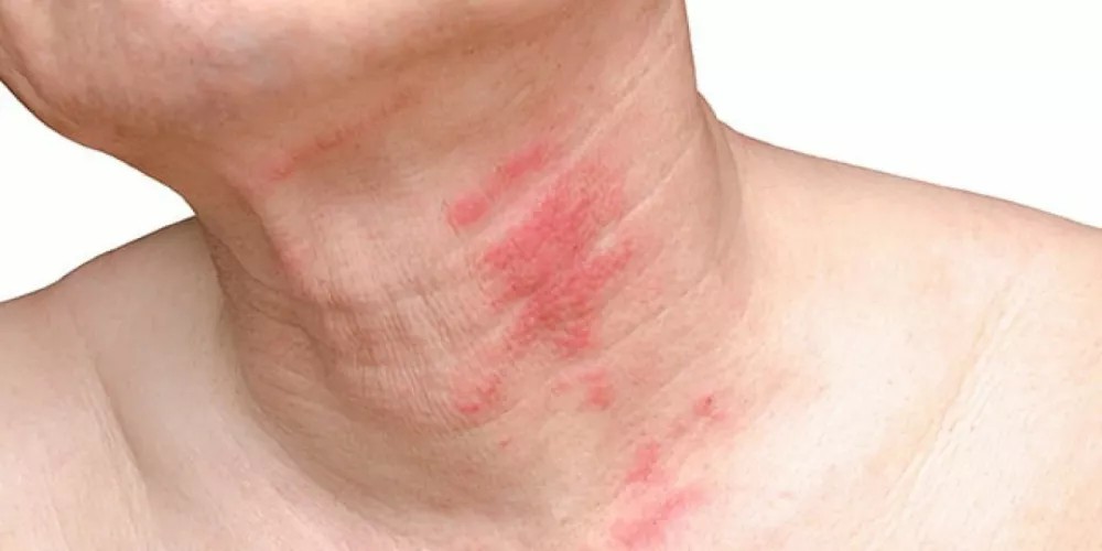 الحزام الناري.. الأعراض والأسباب وطرق العلاج الفعالة الحزام الناري