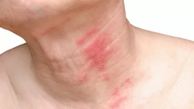 الحزام الناري.. الأعراض والأسباب وطرق العلاج الفعالة الحزام الناري