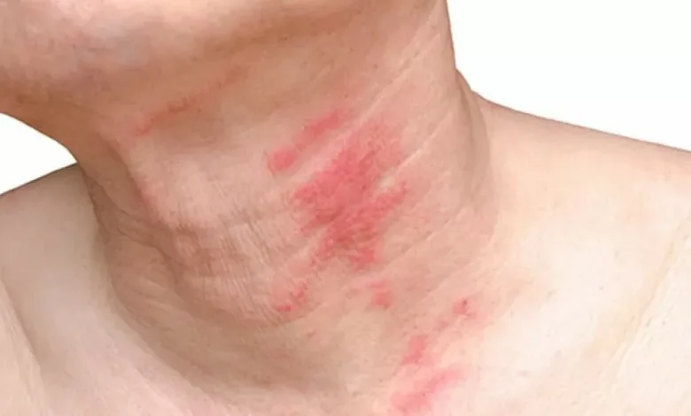 الحزام الناري.. الأعراض والأسباب وطرق العلاج الفعالة الحزام الناري