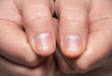 احمرار بسيط في أظافرك قد يكشف مرضًا خفيًا احمرار الاظافر