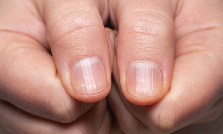 احمرار بسيط في أظافرك قد يكشف مرضًا خفيًا صورة توضيحية لاحمرار الأظافر